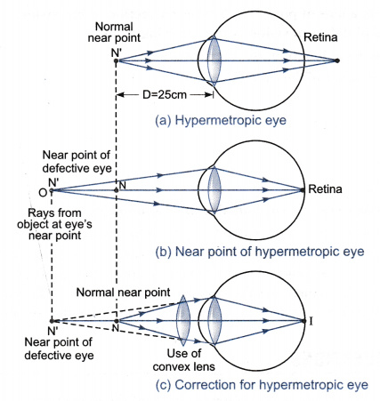 Hipermetropie - Wikipedia