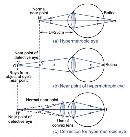 hyperopia 10)