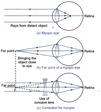 myopia diagram class 10